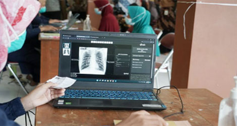 Indonesia Hadapi Ancaman Serius Tuberkulosis, Investigasi Kontak Diperkuat