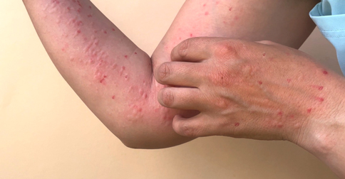 Kasus Monkeypox Bertambah di Indonesia, Penularan Akibat Sex Berisiko
