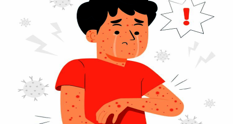 Indonesia Percepat Eliminasi Kusta dan Filariasis, Target Bebas pada 2030