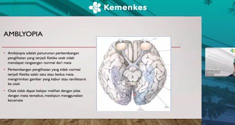 Jangan Sepelekan Mata Malas pada Anak untuk Cegah Kebutaan di Masa Dewasa